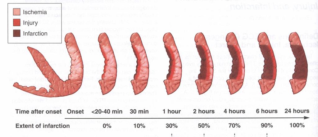 Myokardnekrose Starter 30-45min etter okklusjonen Etter 90min er 40-50% nekrotisert Etter 6t er nekrosen ofte fullstendig