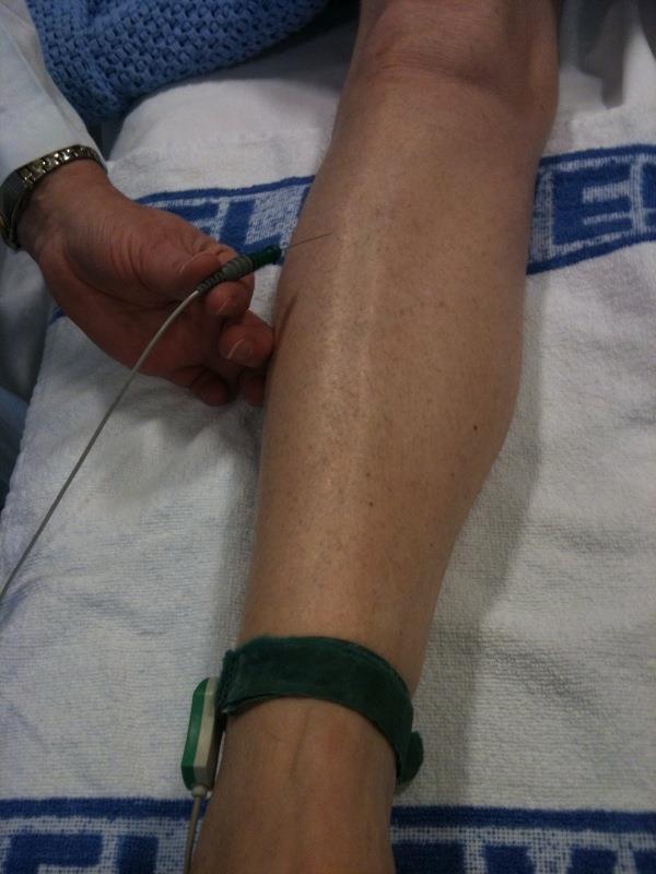 EMG-nål i muskel