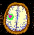 MR-bilder av hjernen Klassifisert