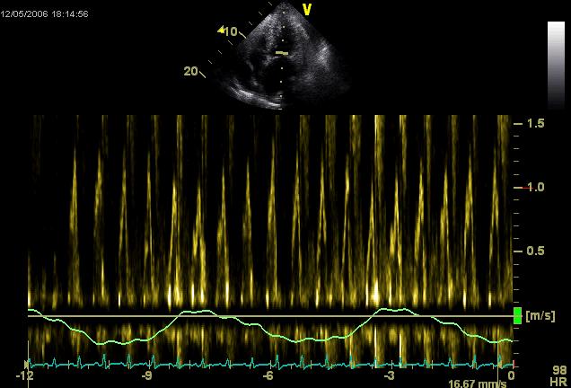 Mitralflow Perikardvæske, lett tamponade SAa 0410