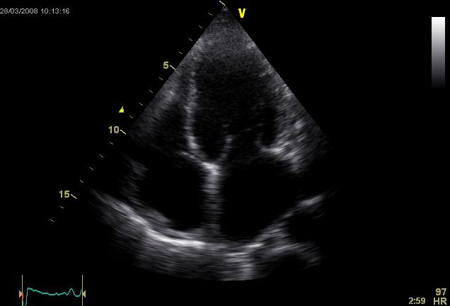 Fortykket perikard Biatrial