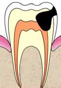 Гел који може изазвати поновни раст оболелих зуба за само неколико недеља ускоро би могао да пломбе пошаље у заслужену пензију.