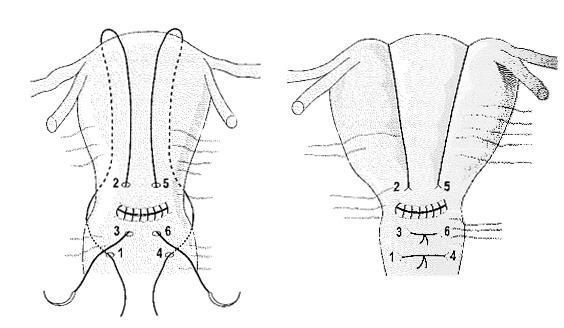 Vedlegg 1: Operasjonsteknikker B-Lynch. Som regel førstevalg ved atoniblødning under keisersnitt. Assistent komprimerer uterus og passer på at suturene blir liggende riktig over fundus.