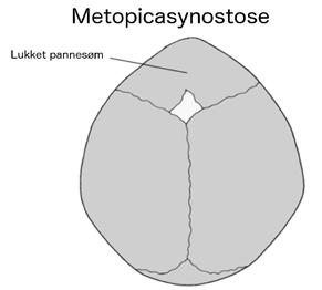 METOPICASYNOSTOSE Metopicasynostose, også kalt trigonocephali, er en av flere typer kraniosynostoser.