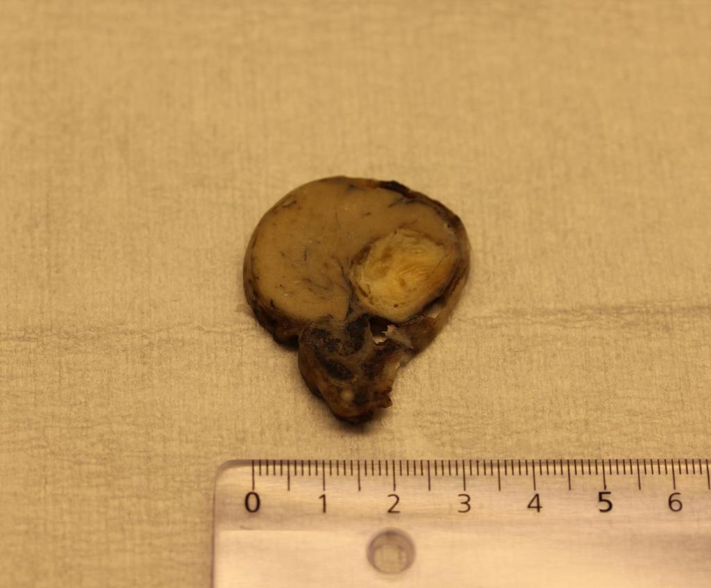 Velavgrenset intratestikulær, cystisk lesjon Diameter: 25 mm.