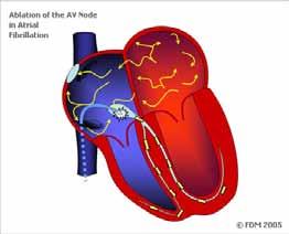 צריבה )אבלציה( בפרוזדור השמאלי אבלציה, נקראת גם left atrial circumferential או pulmonary vein isolation ABLATION) ablation,(pvi מתבססת על צריבות עם קטטר של אזורים שונים בעלייה השמאלית של הלב, שמטרתן