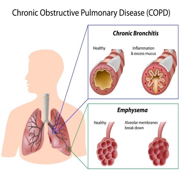 Kronsik obstruktiv lungesykdom 250-300 000 mennesker lever med kols i Norge Helsedirektoratet 2012 Ca.