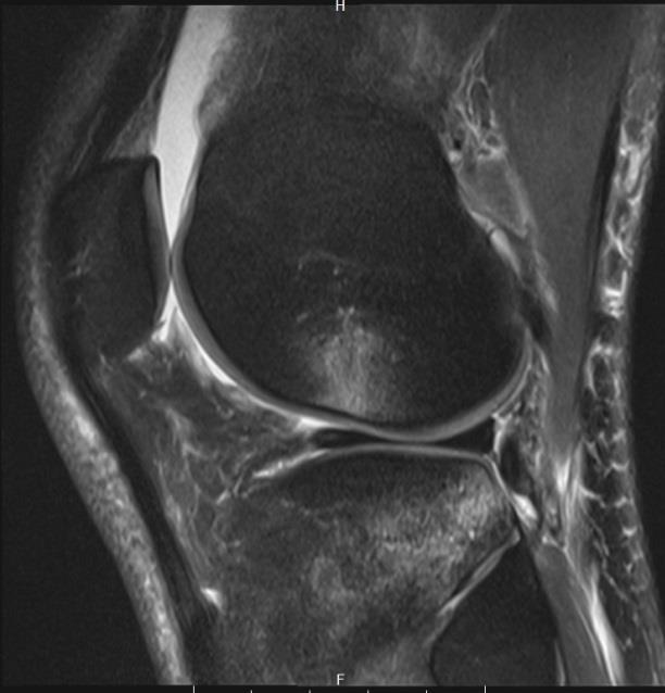 bruise Anterior tibial