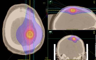 Utfordring: Høye stråledoser affiserer normalvev Radionekrose kan induseres Kan være vanskelig skille radionekrose fra tumorprogresjonnokså hyppig