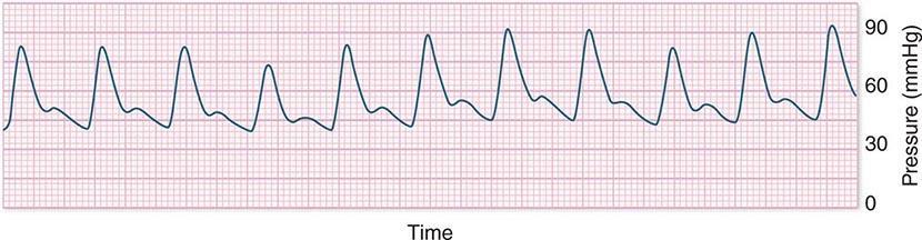 Respirasjonsfrekvens Pulsfylle Narrowed pulse pressure