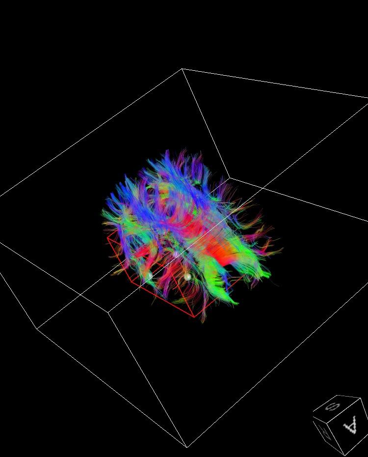 Traktografi basert på DTI Diffusion tensor imaging Cerebrale MRI-funn