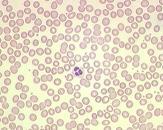 Dyserytropoiese - funn i perifert blod anemi; Anemi