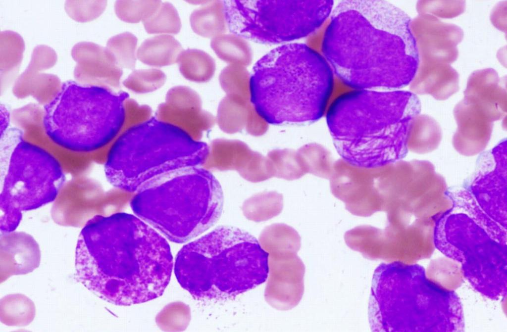 hypergranular acute promyelocytic leukemia.