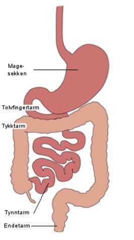 Irritabel tarm (IBS) Plagene som oppleves ved IBS kan oppstå når ufordøyde karbohydrater kommer ned i