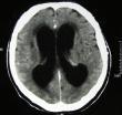 Sekundær demens (intrakranielle årsaker) Normaltrykkshydrocefalus Hjernesvulst(er) Subduralt hematom Post-anoksi Encefalitt(Herpes) Epilepsi Posttraumatisk Borreliose(flåttbitt) Alkoholisme