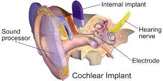 Oppsummering av lydens vei med Cochlea implantat Lydbølger treffer lydprosessor Lydprosessor omgjør akustiske signaler om til elektrisk signal og sender disse via spolen til