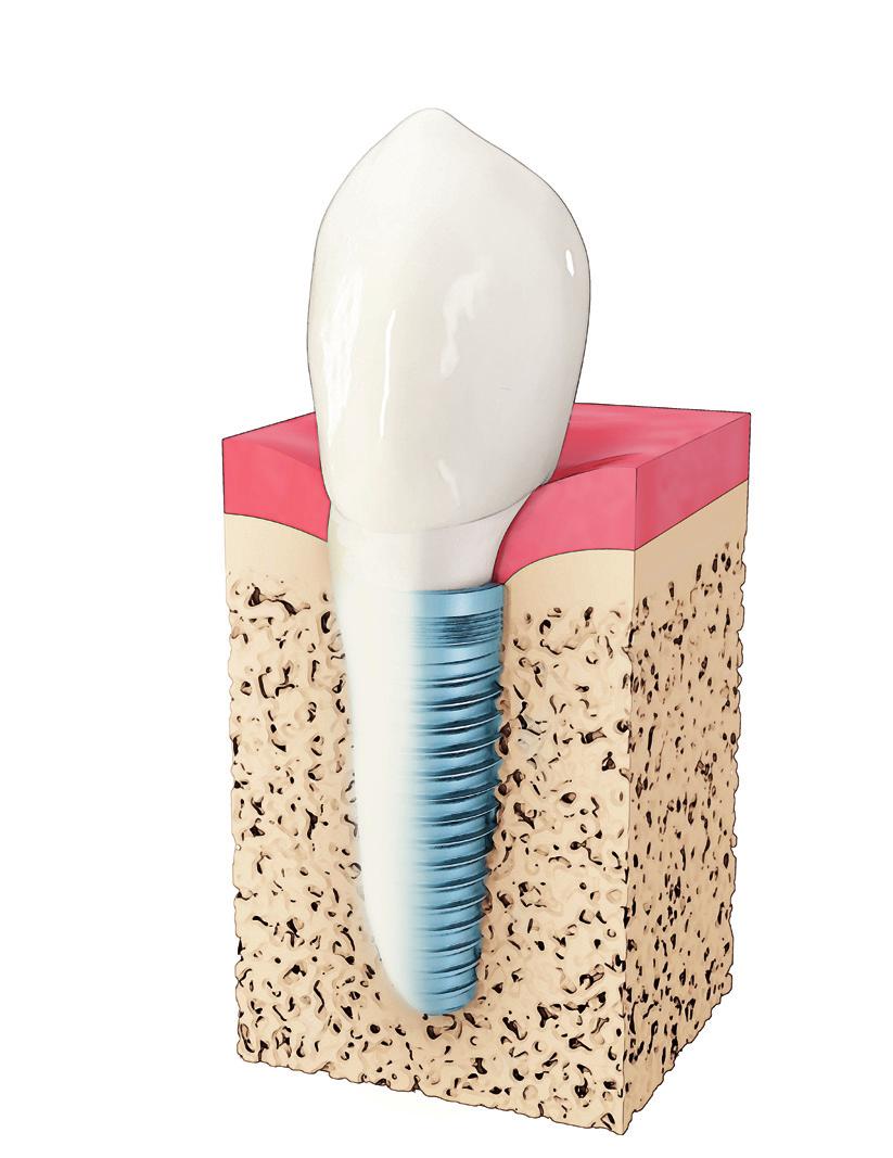 Tannimplantater har mange fordeler Hva er et tannimplantat? Et tannimplantat fungerer som tannrot for den nye tannen.