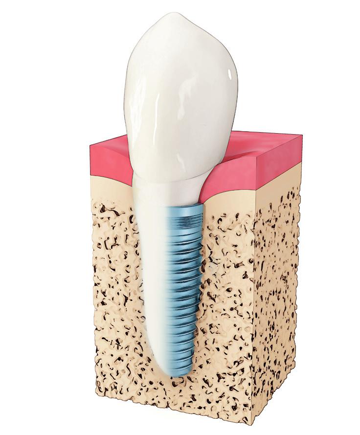 Tannimplantater har mange fordeler Hva er et tannimplantat? Et tannimplantat fungerer som tannrot for den nye tannen.