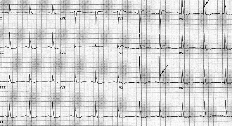 Ca: EKG