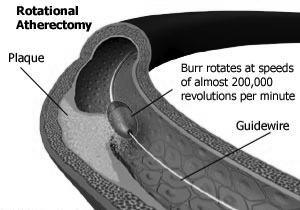 Rotablator (rotational atherectomy) ved forkalkninger som hindrer