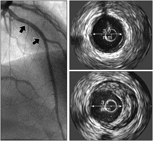 IVUS Eksempel på