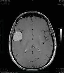 Insidensøkning av CNS-svulster Mange studier har rapportert økende forekomst av CNS-svulster, særlig de godartede svulstene Selv om mange har hatt mistanke om at endringen i