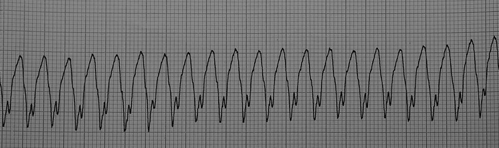 AVRT (ATRIOVENTRICULAR REENTRANT TACHYCARDIA) ANTIDROM TAKYKARDI (<10%) -> ANTEROGRAD KONDUKSJON VIA DEN EKSTRA BANEN TIL VENTRIKKELENE, SÅ RETROGRAD