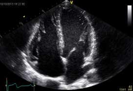 Vevs-Doppler Vevshastighet Strain