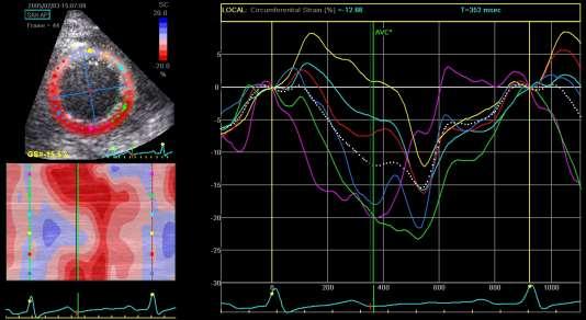 Strain, speckle tracking echo (STE) Dimensjoner