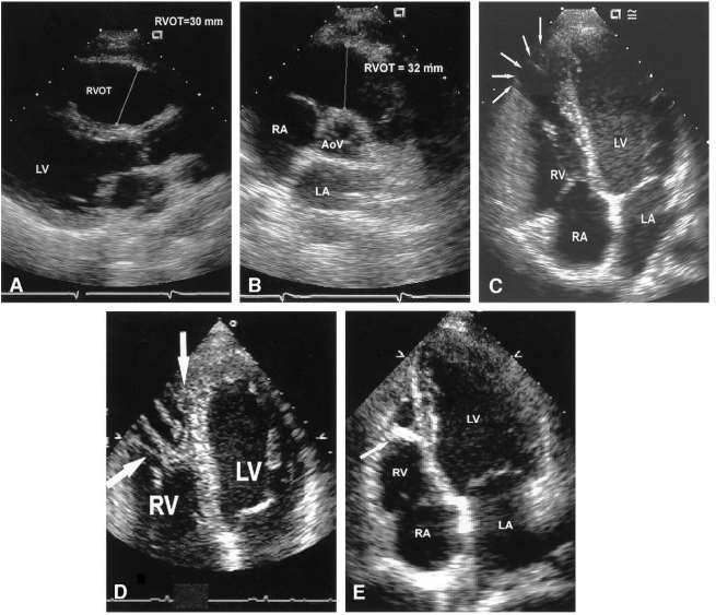 A. RVOT dilatert (PSLAX) B.