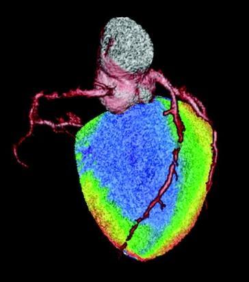 Adenosin stress Adenosin virker vasodilaterende på koronar kar, men dilaterer ikke faste stenoser.