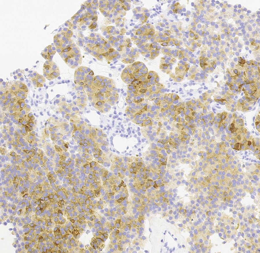 Chromogranin og Synaptophysin.