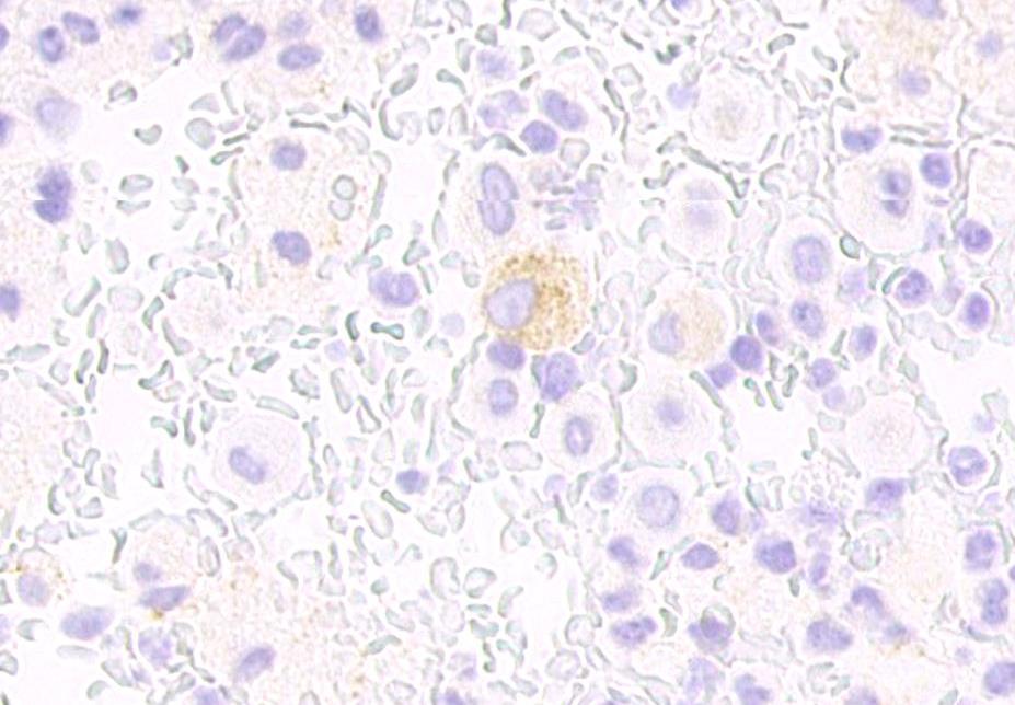 Thyrogl TTF-1 De cytologiske prøvene ble nå sammenholdt med det histologisk