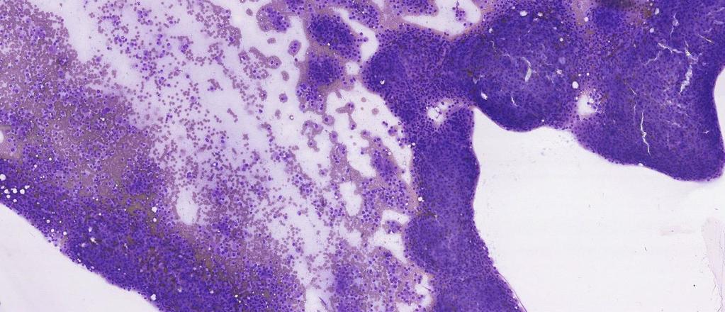 FNAC fra høyre thyroidealapp ble besvart som cellerikt bilde fra follikulær neoplasi med Hürtlecellemetaplasi, mulig karsinom.