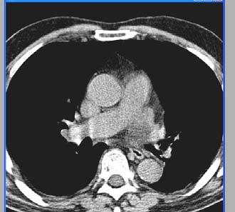 Figur 9: CT bilde av thorax som viser lungeemboli.