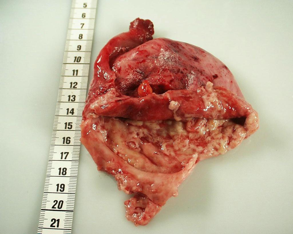 Cystisk ovarium med vedhengende tube, mottatt åpnet og tømt.