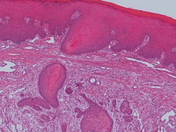 WHO histological classification of salivary gland tumors 2017 Benign epithelial tumors Pleomorhic adenoma Myoepithelioma Basal cell adenoma Warthins tumor Canalicular adenoma