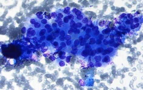 gland -Oncocytic cells no