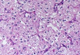 Acinic Cell Carcinoma Female 65