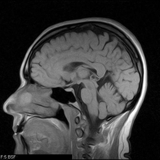 Strukturell MRI Brukt primært i psykiatri til: Volumetri og øvrig morfometri Måle