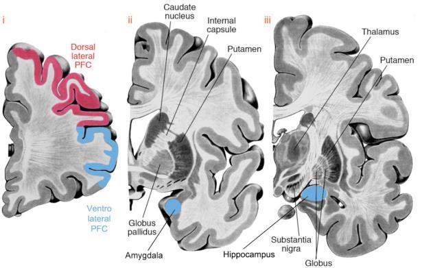 Schizophrenia MRI Caudate nucleus a Reduced grey and white matter Enlarged