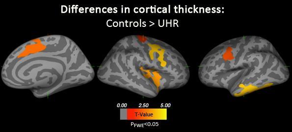 Kortikal tykkelse: UHR vs kontroller UHR hadde redusert tykkelse i