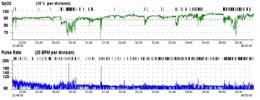 Transcutan pco 2 registrering Definisjon søvn hypoventilasjon: