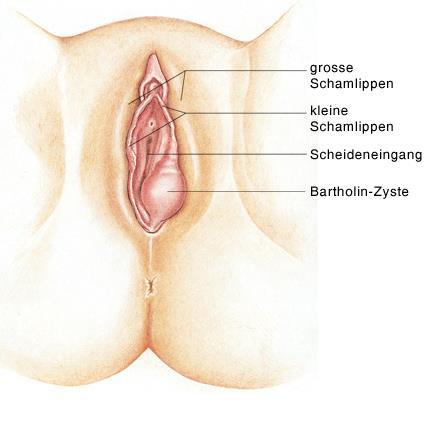 BARTHOLINITT Symptomer/funn: -smerter,hevelse,rubor - almensymptomer/feber -evt.