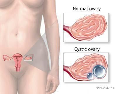 OVARIALCYSTER- RUPTUR/ TORSJON Ovariene er cysteproduserende organer Ved