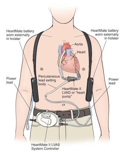 LVAD Left ventricular assist device