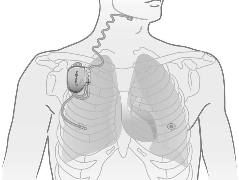 3. Inspire-behandling med stimulering av øvre luftveier Ditt Inspire-system Stimuleringsledning Stimulator Ledning for registrering av respirasjon Figur 2.