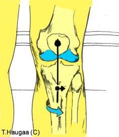 Venstre: Når kneet er flektert, plasser et punkt på patella og et punkt på tuberositas