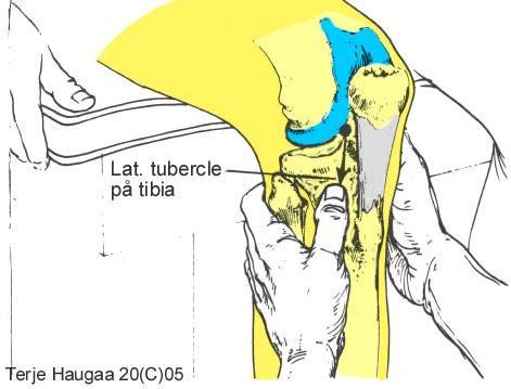 6.3 Palpasjon av laterale tubercle på tibia T. Haugaa Fig 106.