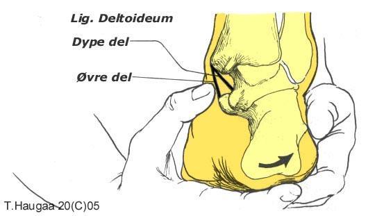 4.28 Ligg. deltoideum T. Haugaa Fig 060. Ligg. Deltoideum er et meget sterkt leddband, og kan palperes på medialsiden.